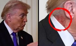 Trump'ın boynunda gizemli kızarıklık gündem oldu! Doktorundan açıklama geldi...